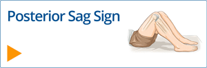 Posterior Sag Sign