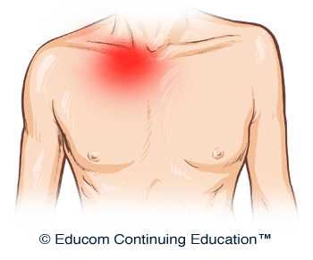 Sternoclavicular-Pain