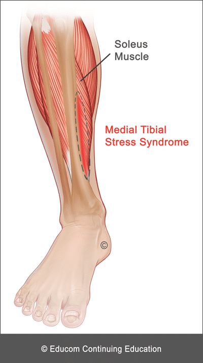 Medial-Tibial-Stress-Syndrome