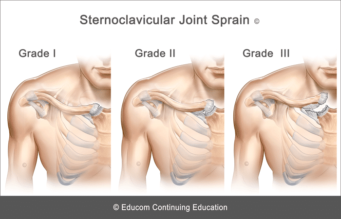 Types-Sternoclavicular-Joint-Sprain