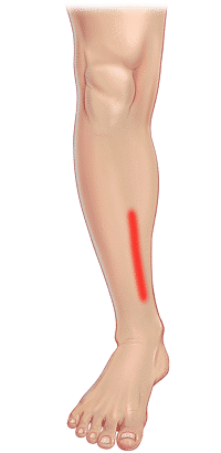 Leg Pain - Chiropractic Online CE